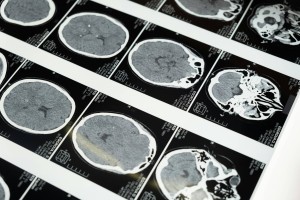 CT Scan